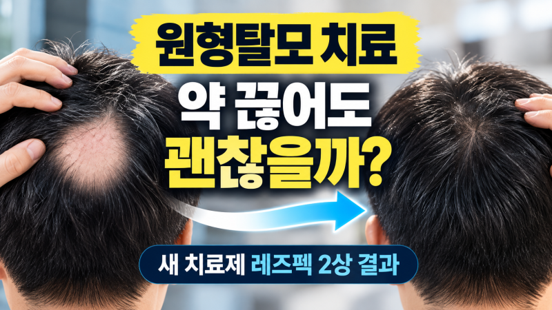 원형탈모 치료, 약을 끊으면 다시 빠질까? 새로운 치료제 레즈펙이 주목받는 이유