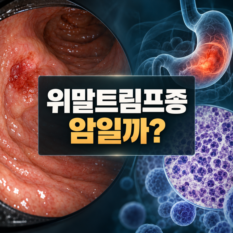 위말트림프종은 암일까? 증상과 치료방법 알아보기