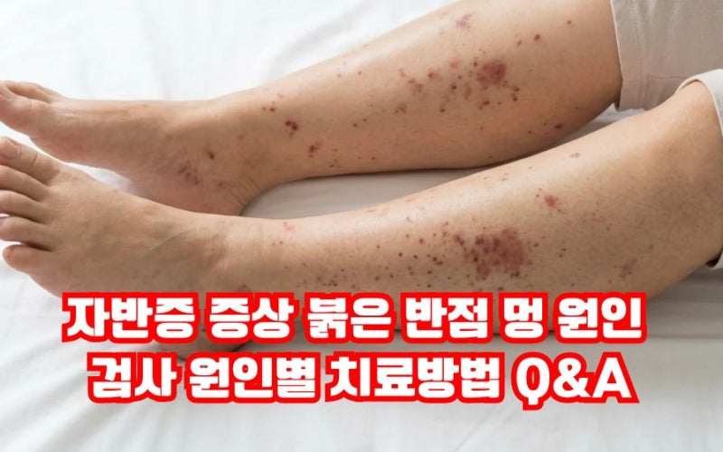 자반증 증상 붉은 반점 멍 원인 검사 원인별 치료방법 Q&A