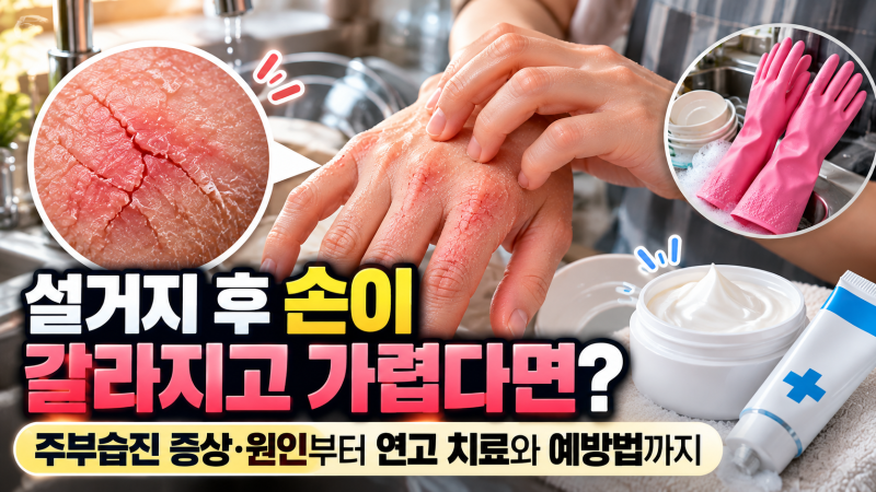 설거지 후 손이 갈라지고 가렵다면? 주부습진 증상·원인부터 연고 치료와 예방법까지