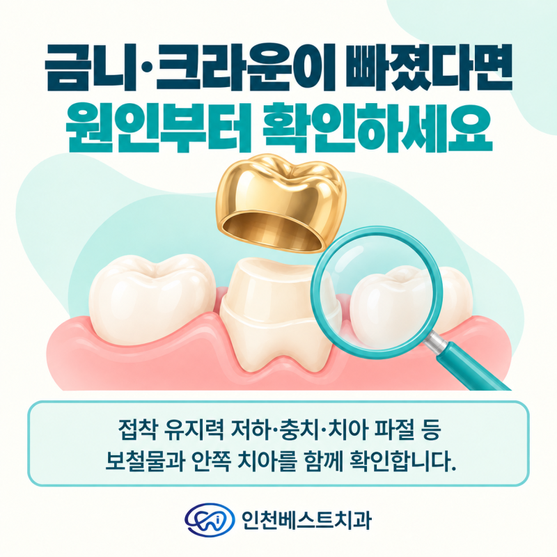 옥련동 치과, 금니가 떨어졌는데 다시 붙일 수 있을까요?