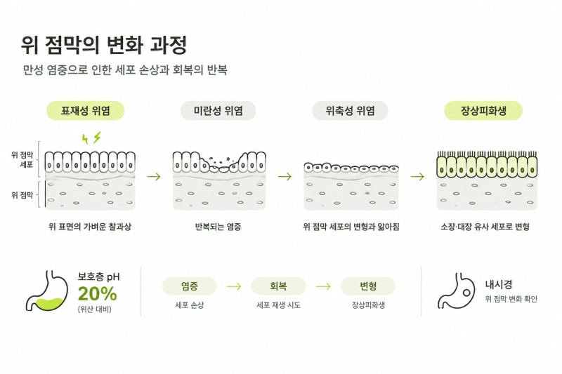 위축성 위염, 장상피화생 약 없이 치료하기