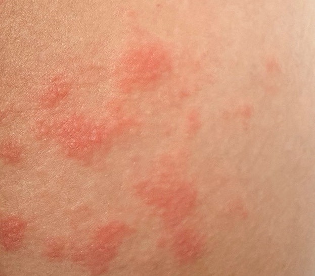 30대 대상포진 초기증상 수포 가려움 한달 완치 후기(근육통 오진, 아토베리어 잇칭크림 실사....