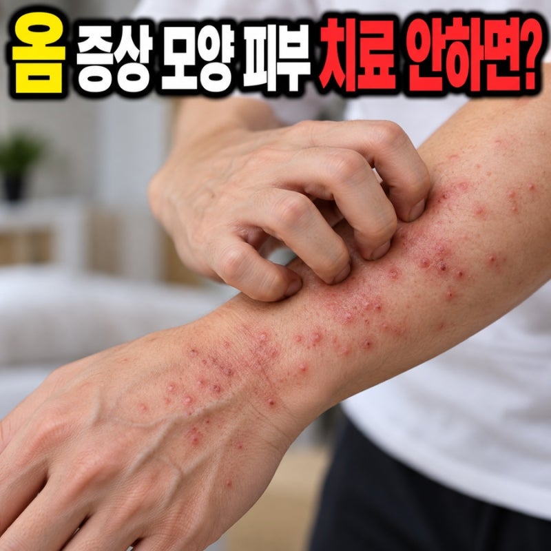 옴 증상 모양 피부 치료 안하면? 밤만 되면 미친듯이 가렵다면 의심하세요