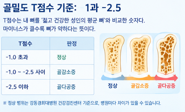 골밀도 T점수 -1, -2.5는 무슨 뜻일까? 골감소증·골다공증 기준 정리