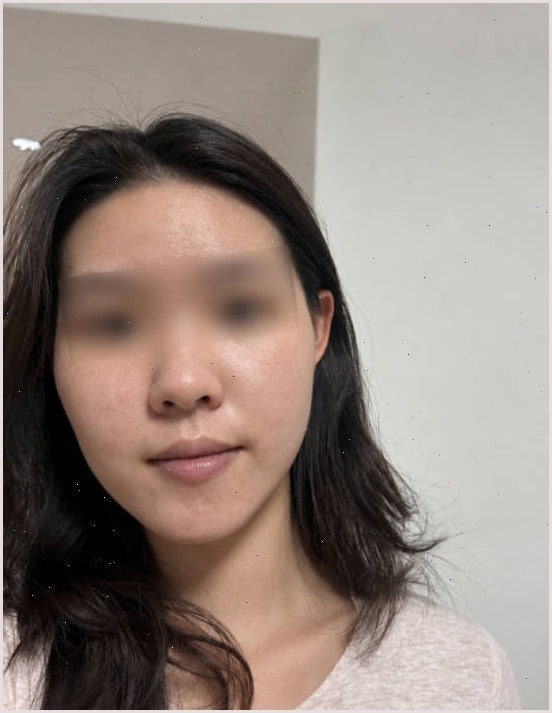 여드름 염증주사 두 달 관리(+최근 변화)