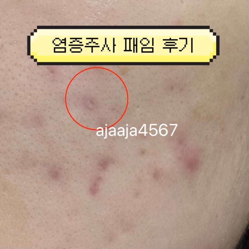 여드름 염증주사 패임 부작용 복구 후기 | 염증주사 가격 효과