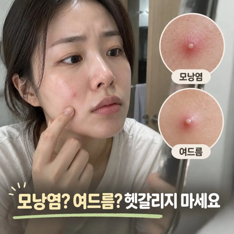 모낭염 증상과 원인, 여드름과 구분하는 법