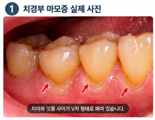 치경부 마모증, 치아가 왜 이렇게 패였을까요? 꼭 때워야 할까요?(시린이) 만수동치과에서 알....