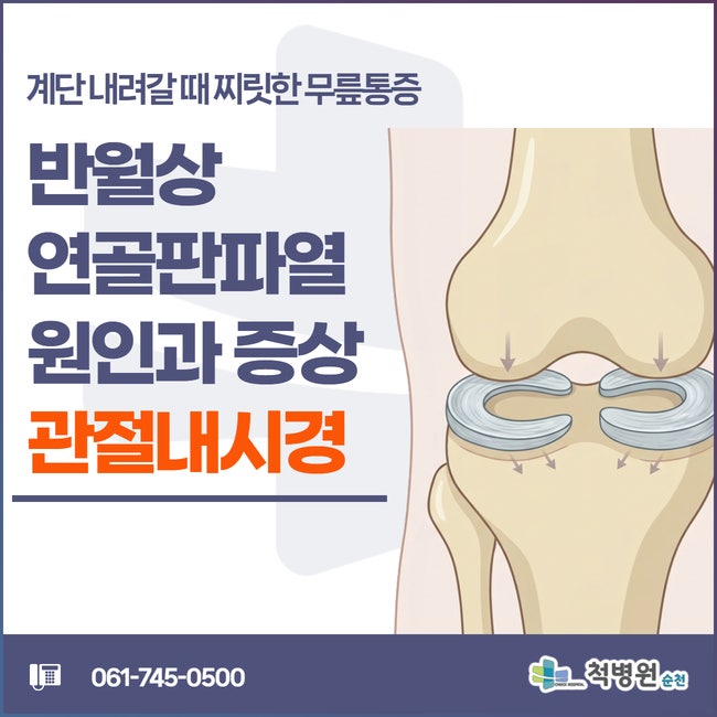 무릎통증원인, 반월상연골판파열 주요 원인과 증상, 관절내시경치료법ㅣ광양·여수 관절병....