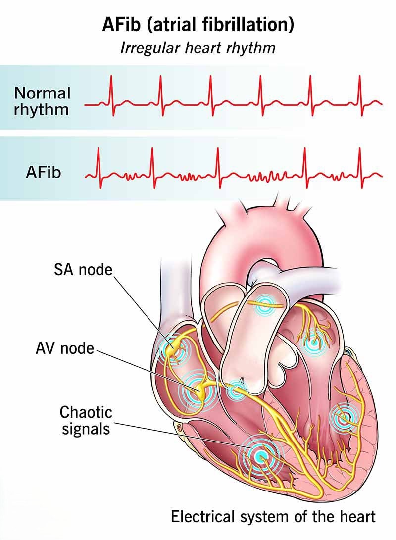 심방세동 Atrial Fibrillation: 심장이 자기 박자를 잊은 밤