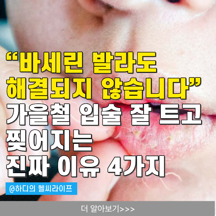 “바세린 발라도 해결되지 않습니다” 가을철 입술 잘 트고 찢어지는 진짜 이유 4가지