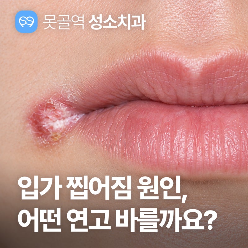 입가 찢어짐 피날 때 구순구각염, 어떤 연고 바를까요?