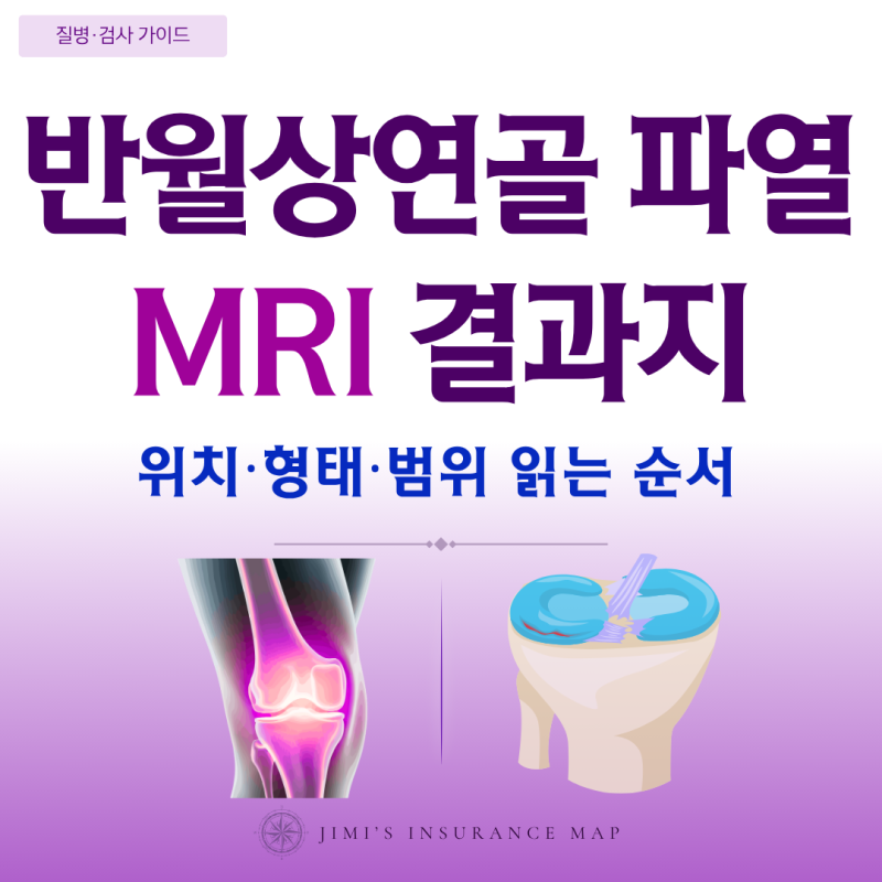 반월상연골 파열 MRI 결과지의 위치·형태·범위는 어떻게 읽을까?