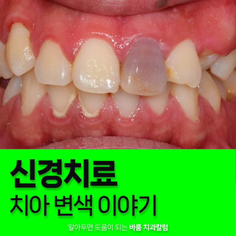 신경치료 후 앞니가 검게 변했다면