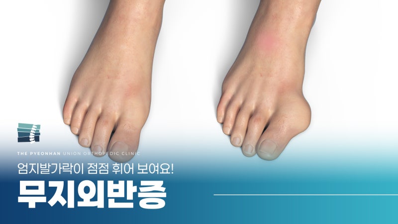 대구 무지외반증 병원, 엄지발가락이 점점 휘는데 교정할 수 있을까요?