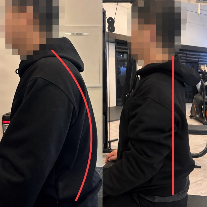 굽은어깨교정, 어깨를 펴도 그대로인 이유