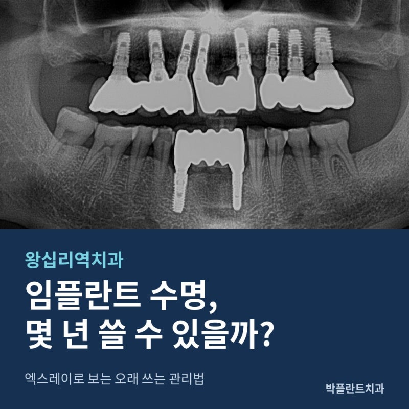 왕십리역치과 임플란트 수명, 몇 년 쓸 수 있을까?