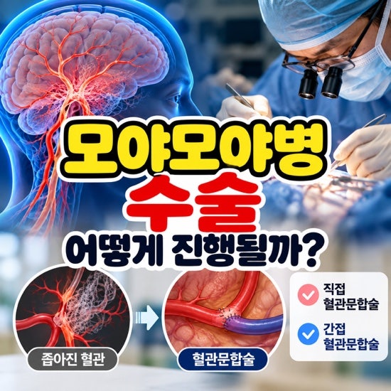 모야모야병 수술, 어떻게 진행될까? 직접·간접 혈관문합술 차이