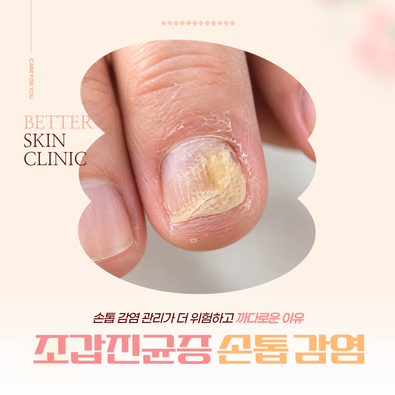 조갑진균증 손톱 감염 시 관리가 더 위험하고 까다로운 이유