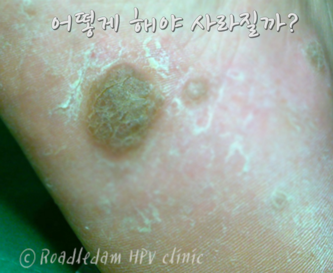 발바닥 사마귀 원인 증상, 티눈과 구분하여 재발 막는 치료