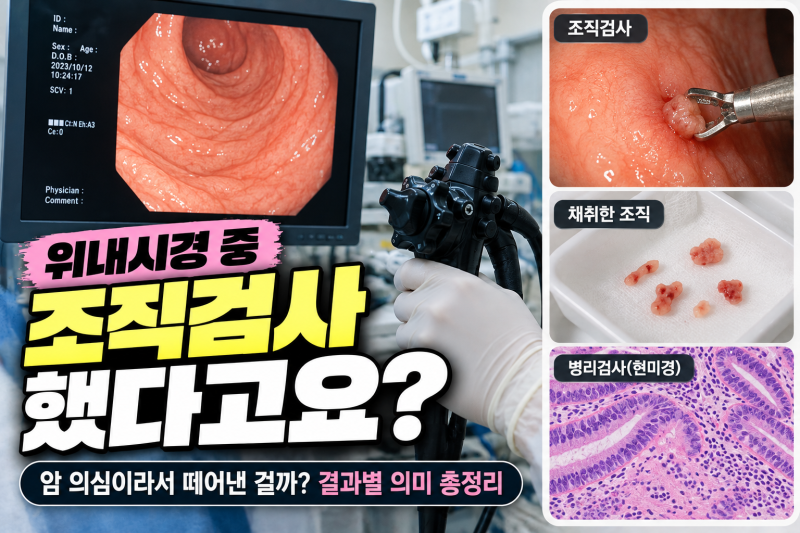 “위내시경 중 조직검사 했다고요?” 암 의심이라서 떼어낸 걸까…결과별 의미 총정리