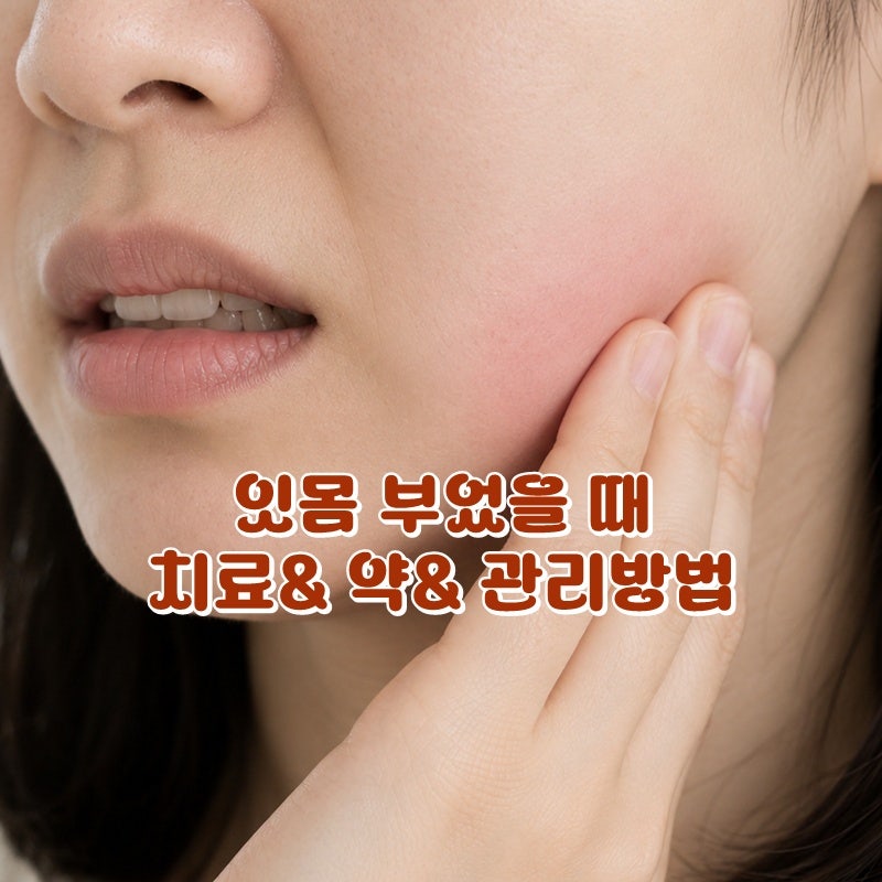 잇몸 부었을때 약 치과 치료 직접 후기