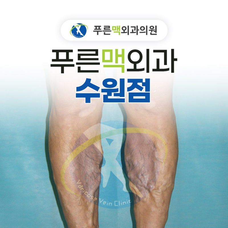수원하지정맥류 병원 고를 때 3가지 확인하세요 | 푸른맥외과 수원