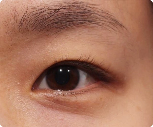 눈밑 한관종, 원인부터 치료 과정까지 직접 받아본 아그네스 치료 후기