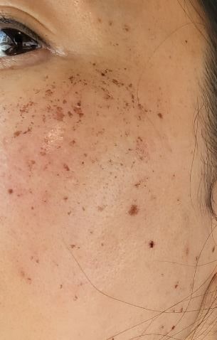 기미 토닝 레이저 후 관리 방법 [멜라논 크림]