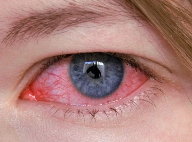 결막염 Conjunctivitis: 눈이 빨개진 날, 인류는 무엇을 몰랐을까요?