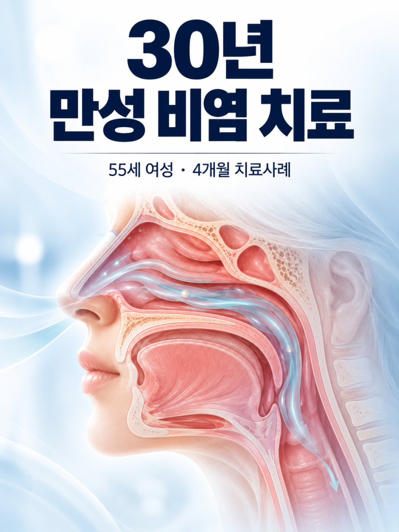 만성 비염 치료, 재발성 비염 30년 코 간지러움과 후비루 가래가 개선된 55세 여성 사례