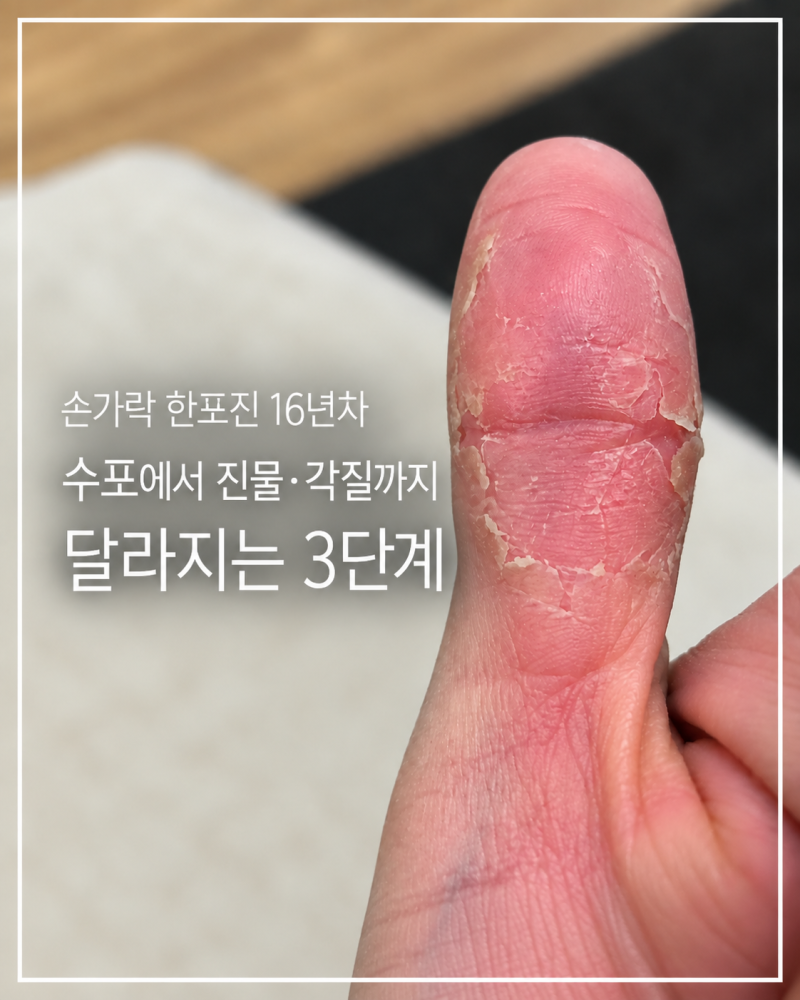 손가락 한포진 16년차｜수포에서 진물·각질까지 달라지는 3단계