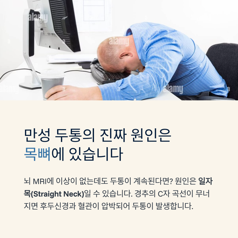 만성 두통 부르는 일자목, 원인과 확실한 해결책