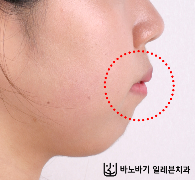 무턱 교정, 턱끝수술이 꼭 필요할까요? (치아교정 vs. 수술교정 진료 후기 비교)
