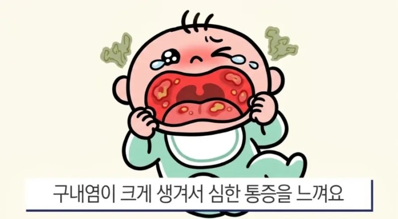 소아 구내염 원인·증상별 약 종류 및 가정 대처법 (수족구/헤르판지나/헤르페스/아프타성)