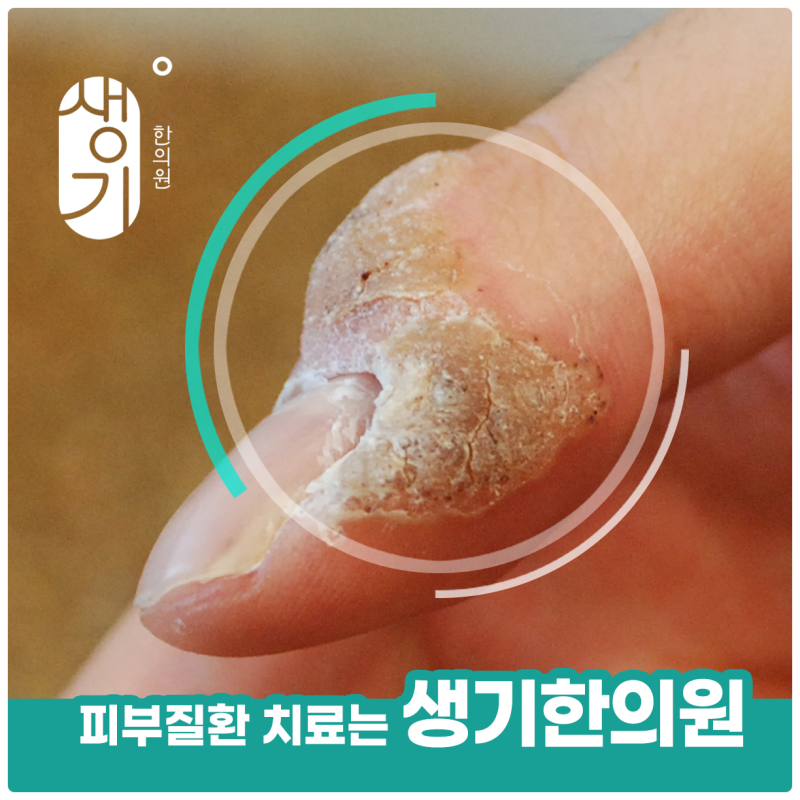 발바닥사마귀 전염, 그냥 두면 가족에게도 옮을까요?
