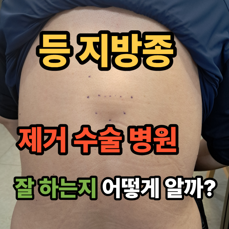 등 지방종 제거수술, 아무 병원에서 받으면 안 되는 이유