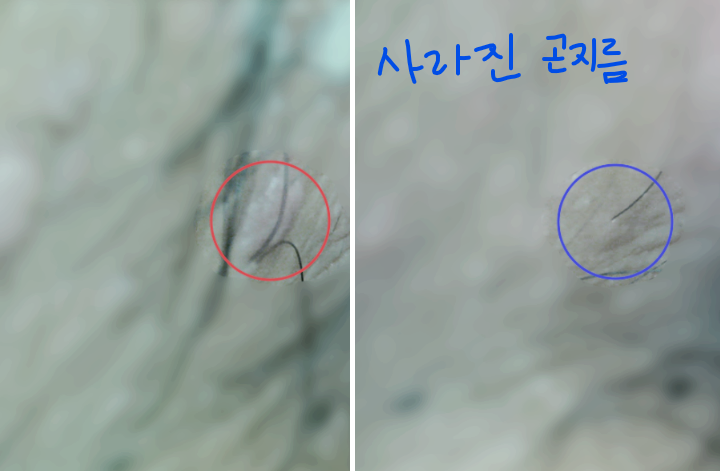 사타구니 곤지름 완치, 원인을 알아야 재발을 잡는다