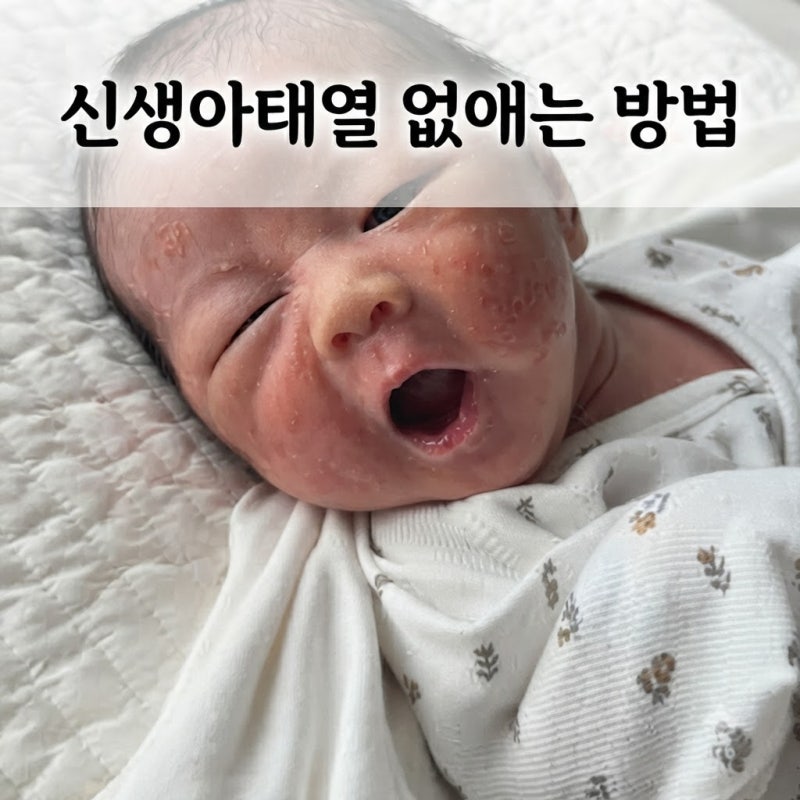 신생아 태열 없애는법 | 온도 습도부터 식염수 팩까지 아기태열 집에서 관리하는 방법