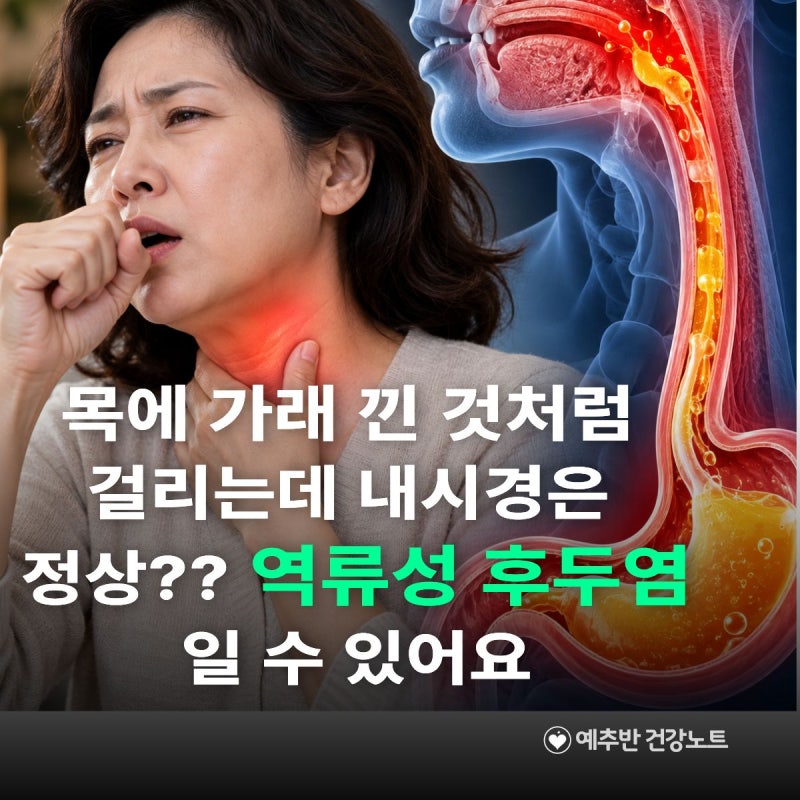 목에 가래 낀 것처럼 걸리는데 내시경은 정상?? 역류성 후두염일 수 있어요