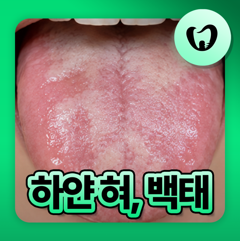 혀가 하얀 이유, 백태 안 없어지는 원인과 제거 방법