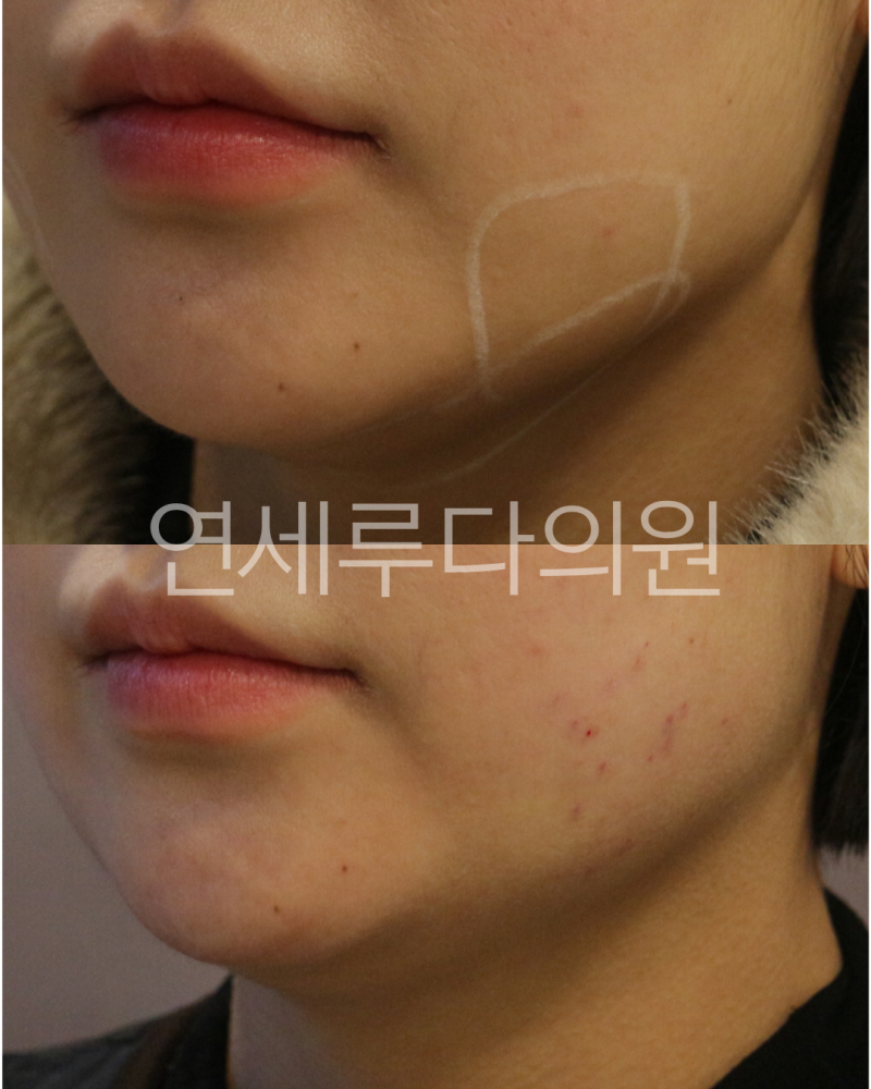사각턱보톡스 가격·후기만 보면 될까요? 효과 시기와 주기까지
