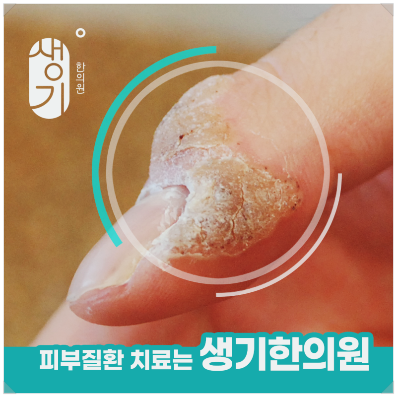 발 사마귀 제거 비용 1회 가격보다 먼저 따져봐야 할 것들