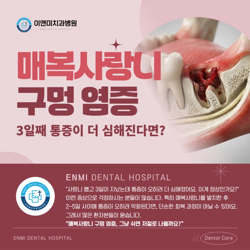 매복사랑니 구멍 염증 3일째 통증이 더 심해진다면? 건성치조염 신호