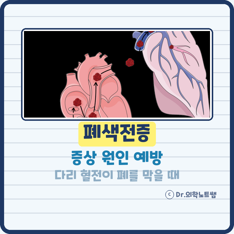 폐색전증 증상 원인 예방, 심부정맥혈전증 혈전과의 관계