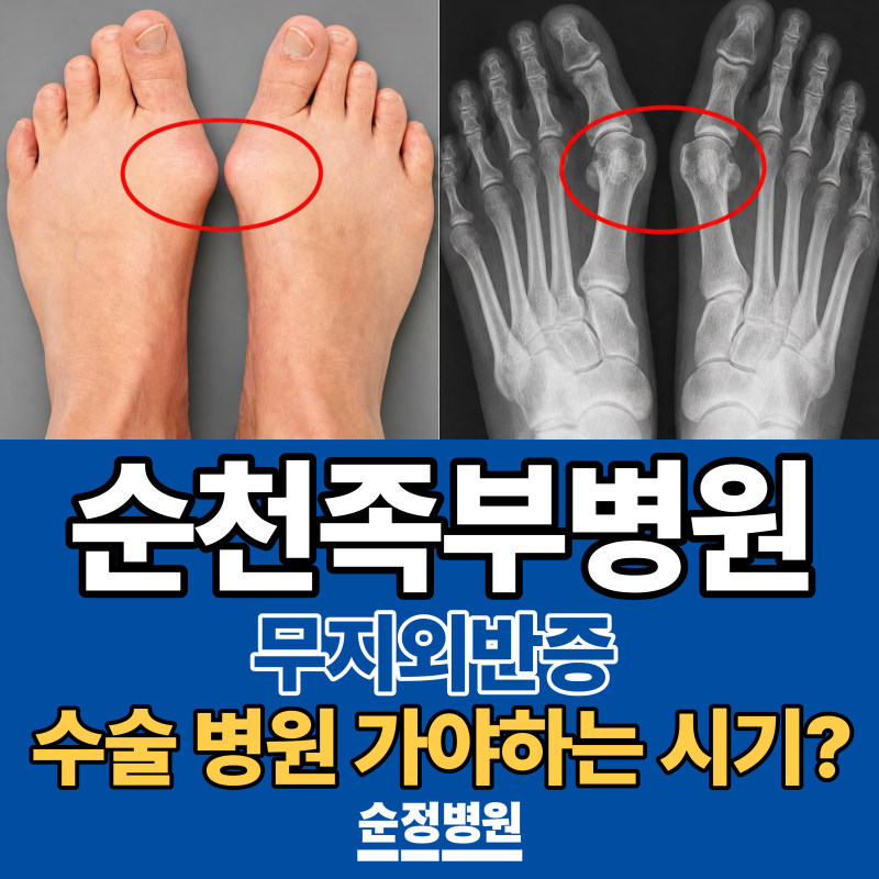 순천정형외과 무지외반증, 발 통증이 반복될 때 확인할 점