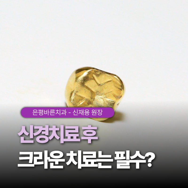 신경치료 후 크라운, 안 아픈데 꼭 씌워야 할까요?