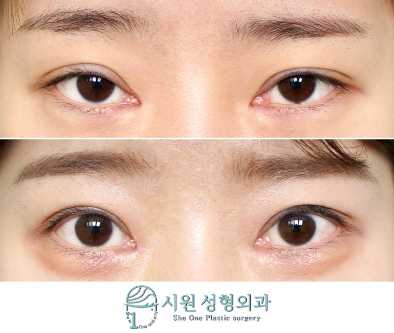 안검하수 재수술, 얼마나 더 올라가나요 434
