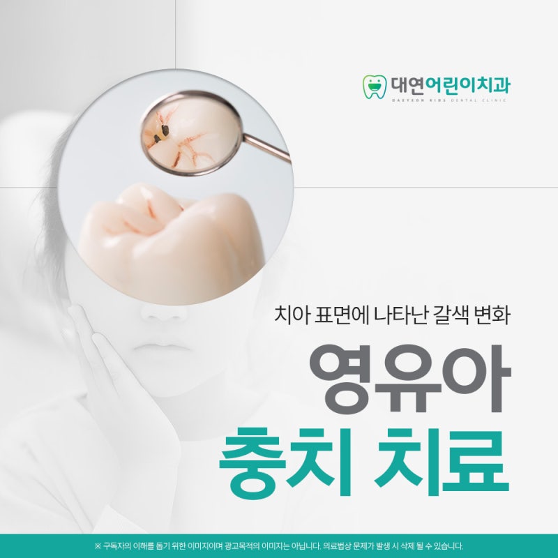 영유아충치치료 작은 점처럼 보일 때와 구멍이 생긴 뒤 치료가 다른 이유